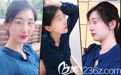 南通康美特聘微整醫(yī)生邵宏案例分享：為什么隆鼻+下巴選擇注射寶尼達玻尿酸