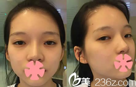 韓國新帝瑞娜(灰姑娘)整形醫(yī)院面部輪廓整形術前照 韓國新帝瑞娜(灰姑娘)整形醫(yī)院面部輪廓整形術前照