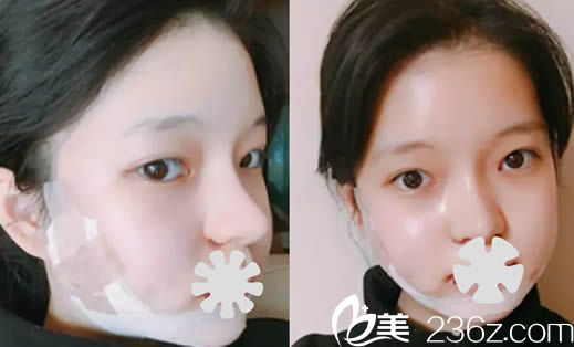 韓國新帝瑞娜整形醫(yī)院面部輪廓術后2天照 韓國新帝瑞娜整形醫(yī)院面部輪廓術后2天照