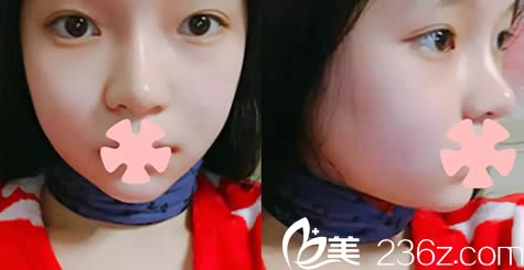 韓國新帝瑞娜整形面部輪廓術后14天照 韓國新帝瑞娜整形面部輪廓術后14天照