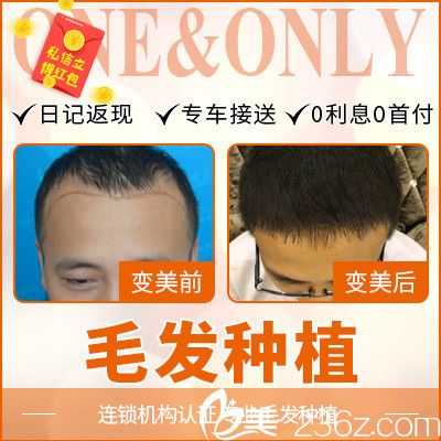 順德壹加壹瑪麗亞游鳳軍做的發(fā)際線種植<span style= 順德壹加壹瑪麗亞游鳳軍做的發(fā)際線種植<span style=