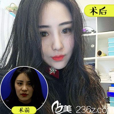 佛山順德壹加壹咼長模做的全臉自體脂肪面部填充<span style= 佛山順德壹加壹咼長模做的全臉自體脂肪面部填充<span style=