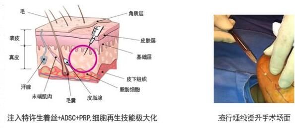 埋線提升有副作用嗎？