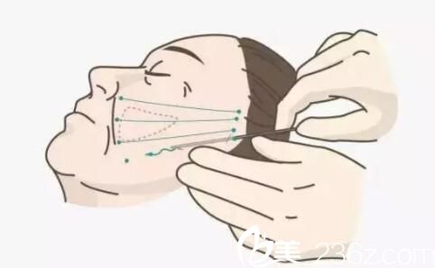 做埋線提升可以做其他項目嗎？