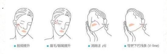 二十幾歲適合做埋線提升嗎？