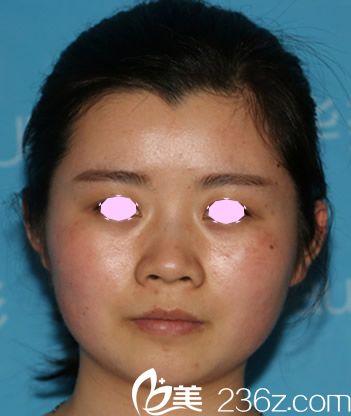 沒有去合肥華美做激光祛紅血絲前