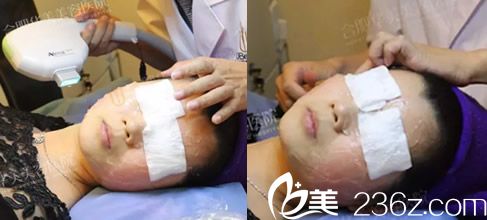 激光祛紅血絲過程中