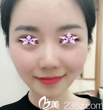 激光祛紅血絲靠譜嗎？看合肥華美激光祛紅血絲效果圖