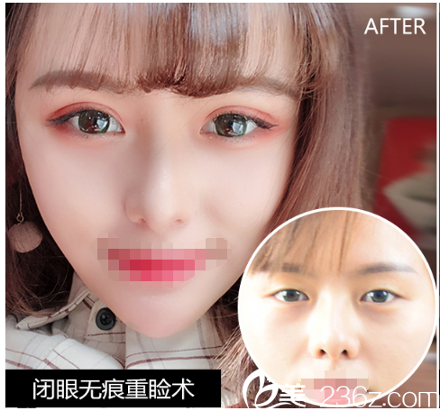 閉眼無痕重瞼術案例 閉眼無痕重瞼術案例