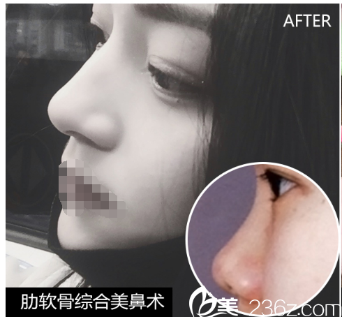 肋軟骨綜合美鼻術案例 肋軟骨綜合美鼻術案例