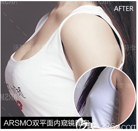 3D動感內窺鏡綜合隆胸術案例 3D動感內窺鏡綜合隆胸術案例