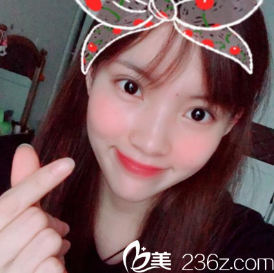 在佛山華美做完雙眼皮一個月自拍 在佛山華美做完雙眼皮一個月自拍