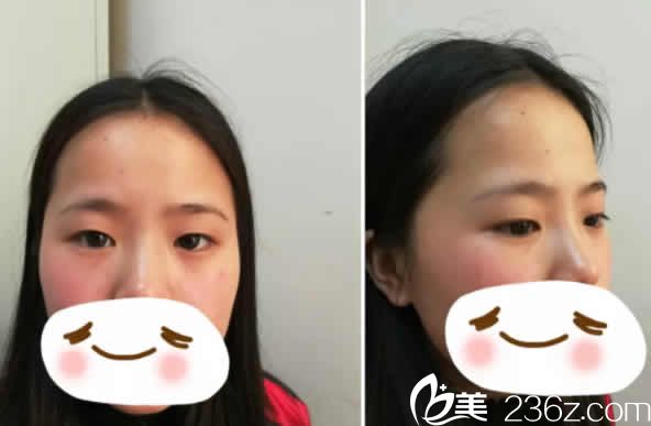 我在太原時光整形醫(yī)院做眼部整形前的照片 我在太原時光整形醫(yī)院做眼部整形前的照片