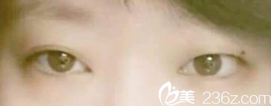 韓國(guó)YNT整形外科醫(yī)院全切雙眼皮手術(shù)前 韓國(guó)YNT整形外科醫(yī)院全切雙眼皮手術(shù)前