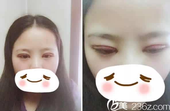 太原時光整形李晨霞醫(yī)生給我做全切雙眼皮加開眼角術(shù)后第3天照片 太原時光整形李晨霞醫(yī)生給我做全切雙眼皮加開眼角術(shù)后第3天照片