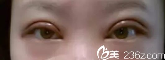 全切雙眼皮手術(shù)第1天 全切雙眼皮手術(shù)第1天