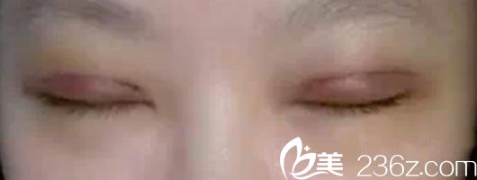 割雙眼皮7天后的恢復(fù)效果 割雙眼皮7天后的恢復(fù)效果