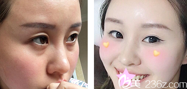 呼和浩特京美內(nèi)切去眼袋一周對比照