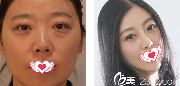 外切去眼袋1-10天變化圖