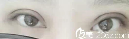 全切雙眼皮20天恢復(fù)圖 全切雙眼皮20天恢復(fù)圖