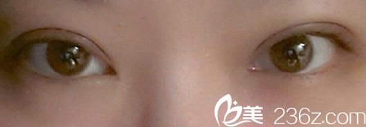  看韓國YNT整形李秉烈給我做全切雙眼皮7mm恢復效果怎么樣