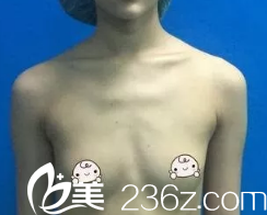 術(shù)前胸部平坦 術(shù)前胸部平坦