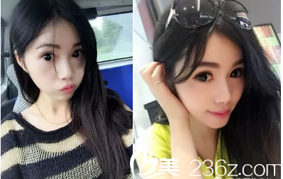 驚呆了！10月2號在整形醫(yī)院做的全切雙眼皮，花了我一萬多