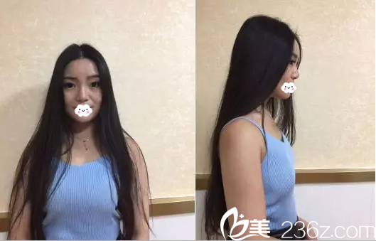 豐胸手術(shù)前胸部只有30B 豐胸手術(shù)前胸部只有30B