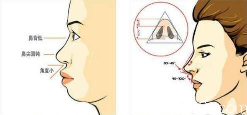 隆鼻失敗的原因