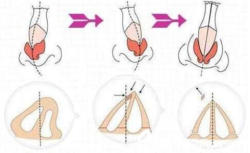 什么是隆鼻修復(fù)