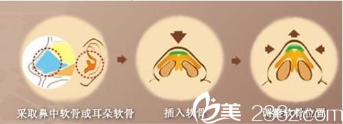 隆鼻修復(fù)手術(shù)方法