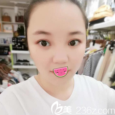 讓老公都夸的全切雙眼皮是成都給我做的