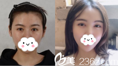 北京美萊劉曉榮切開雙眼皮案例 北京美萊劉曉榮切開雙眼皮案例