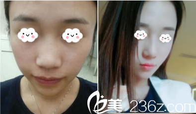 北京美萊劉曉榮鼻綜合案例 北京美萊劉曉榮鼻綜合案例