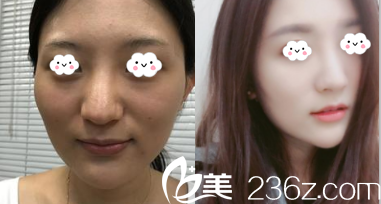 北京美萊劉曉榮面部脂肪精雕案例 北京美萊劉曉榮面部脂肪精雕案例