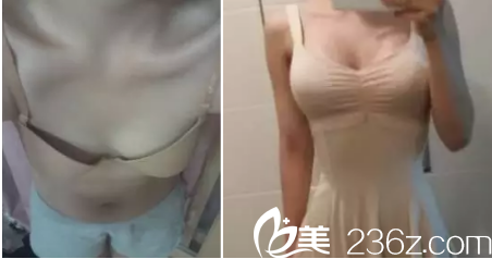 北京美萊劉曉榮脂肪豐胸案例 北京美萊劉曉榮脂肪豐胸案例