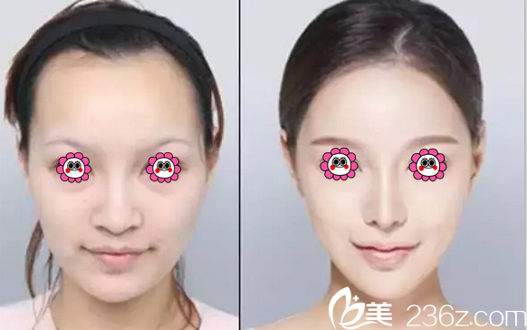 藍(lán)紹梓注射微整真人案例