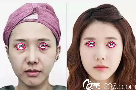 藍(lán)紹梓注射抗衰老真人案例