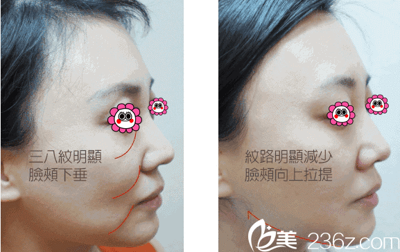 藍(lán)紹梓6D鉆石線(xiàn)雕縱+橫全方位逆齡真人案例