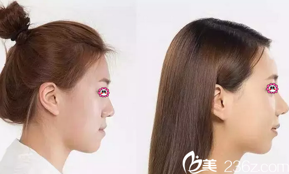 藍(lán)紹梓天使之翼藝術(shù)鼻雕真人案例