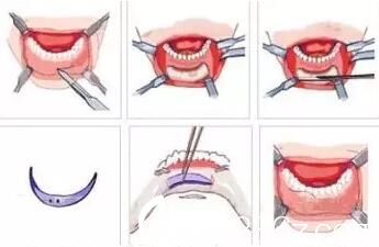 硅膠墊下巴手術(shù)方式
