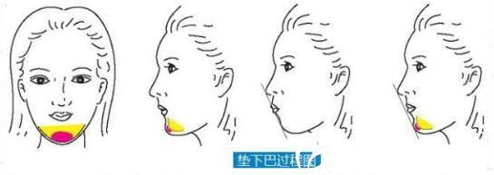 硅膠墊下巴優(yōu)勢