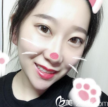 東莞西妃雙眼皮做的蠻好看的,這是劉波院長給我做的眼綜合效果