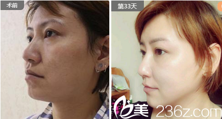 成都精美源周斌面部埋線提升案例 成都精美源周斌面部埋線提升案例