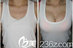 北京<!--<i data=20240703-sp></i>-->（<!--<i data=20240703-sp></i>-->）脂肪豐胸