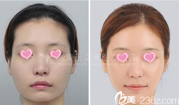 北京潤美玉之光面部脂肪填充