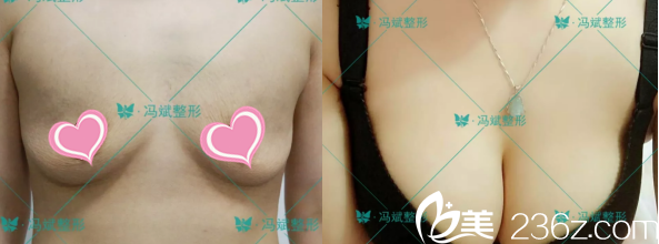 <!--<i data=20240703-sp></i>-->脂肪豐胸