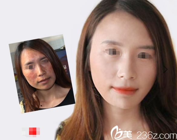 淮安華美皮秒激光祛斑價(jià)格