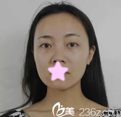 我在聊城韓美整形醫(yī)院做鼻綜合前的照片 我在聊城韓美整形醫(yī)院做鼻綜合前的照片