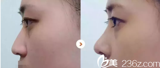 玻尿酸隆鼻案例 玻尿酸隆鼻案例